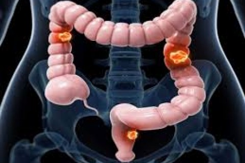 Exames são importantes para diagnóstico do câncer de intestino